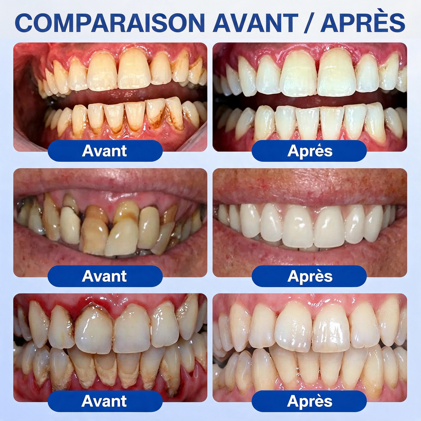 🦷𝐍𝐚𝐭𝐫𝐚𝐯𝐨𝐫® GumRevive Gel de soin des gencives et du parodonte