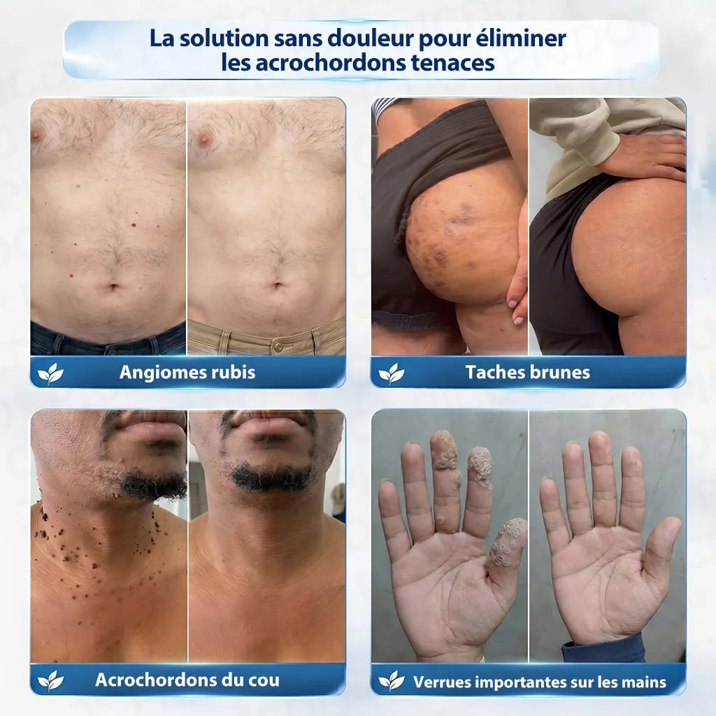 Natravor® 🪴 Crème Éliminatrice de Verrues et Taches Cutanées – 7 Jours (Formule Zéro Douleur, Zéro Cicatrice) 🪴