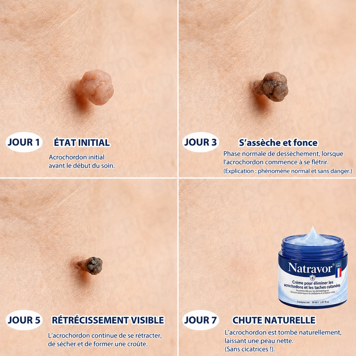 Natravor® 🪴 Crème Éliminatrice de Verrues et Taches Cutanées – 7 Jours (Formule Zéro Douleur, Zéro Cicatrice) 🪴