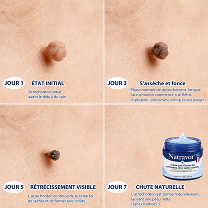 Natravor® 🪴 Crème Éliminatrice de Verrues et Taches Cutanées – 7 Jours (Formule Zéro Douleur, Zéro Cicatrice) 🪴