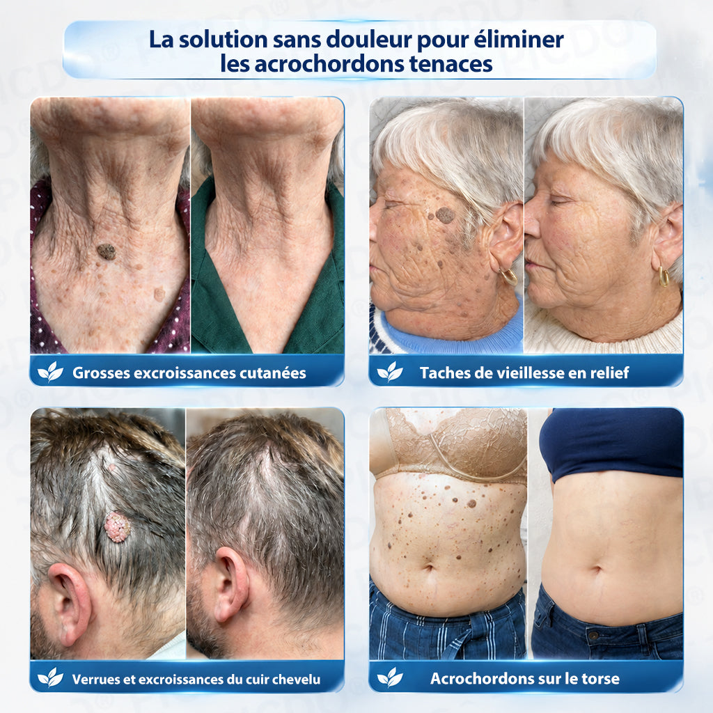 Natravor® 🪴 Crème Éliminatrice de Verrues et Taches Cutanées – 7 Jours (Formule Zéro Douleur, Zéro Cicatrice) 🪴