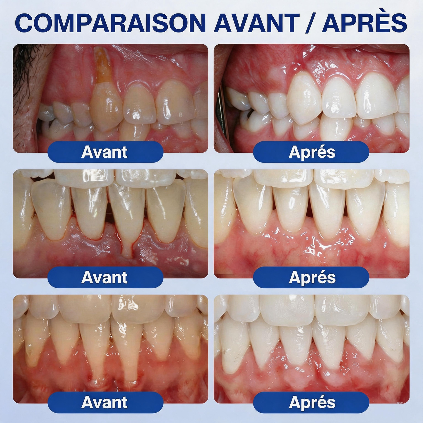 🦷𝐍𝐚𝐭𝐫𝐚𝐯𝐨𝐫® GumRevive Gel de soin des gencives et du parodonte